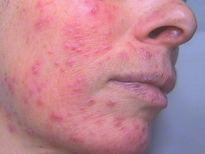 rosacée_papulo-pustuleuse_2