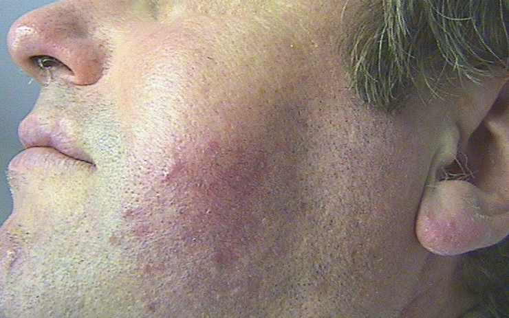 rosacée_papulo-pustuleuse