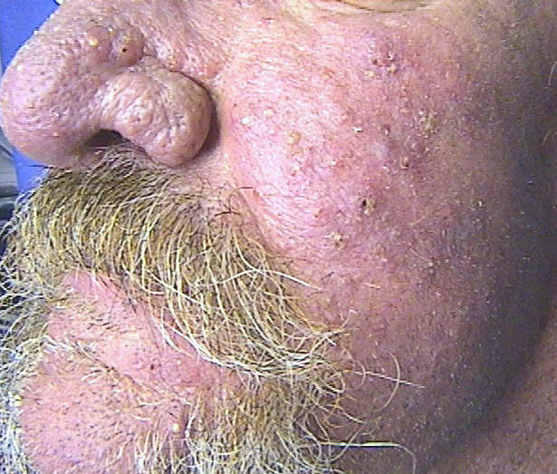 rosacée_rhinophyma IMAGE