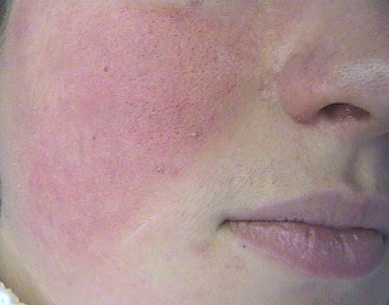 rosacée_vasculaire