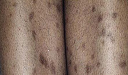 Signes d’inflammation