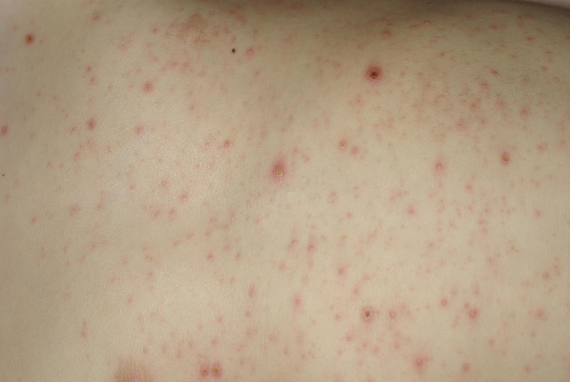 tout-savoir-sur-la-varicelle-dermato-info