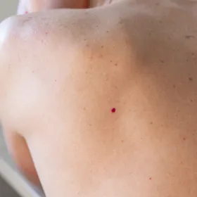 angiomes de loin sur un dos