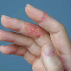 Eczéma de contact DOIGT