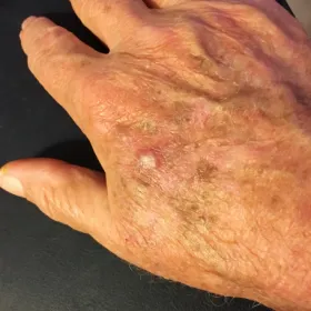 Kératoses actiniques