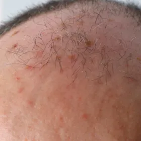 Kératoses actiniques