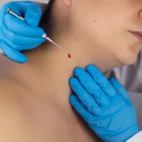  exérèses chirurgicales