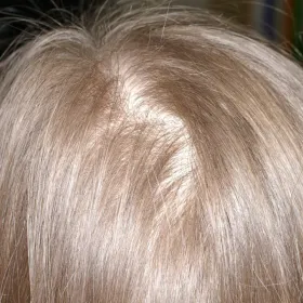 Alopécie androgénétique féminine