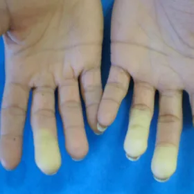 Phase syncopale du Raynaud