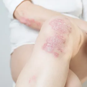 psoriasis 