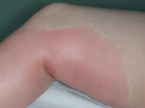Érysipèle