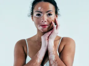 VITILIGO 
