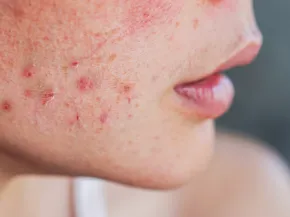 acné
