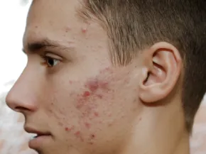 Acné