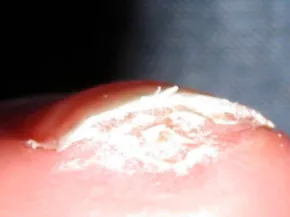 Acrosyndromes