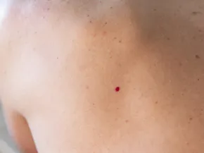 angiomes de loin sur un dos