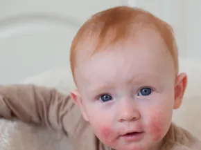 Dermatite atopique enfant