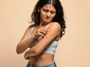 Dermatite atopique photo