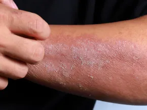 Eczéma de contact BRAS