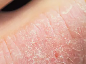 Eczéma de contact CAUSE