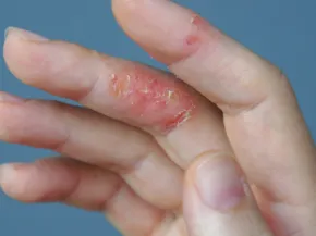 Eczéma de contact DOIGT