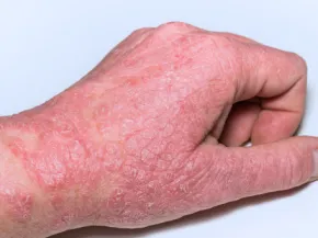 Eczéma de contact