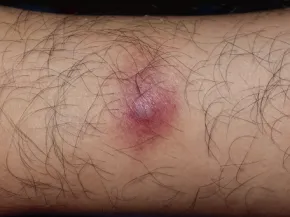 Infections bactériennes