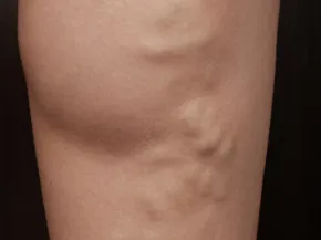 Insuffisance veineuse