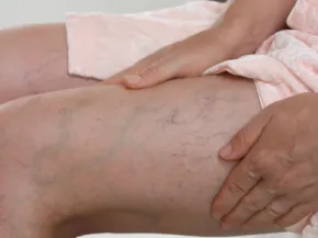 Insuffisance veineuse