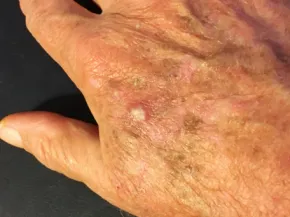 Kératoses actiniques