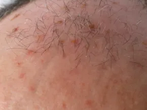 Kératoses actiniques