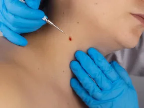  exérèses chirurgicales