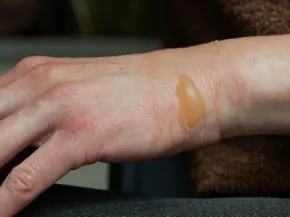 Pemphigoïde bulleuse