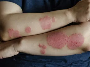 Psoriasis