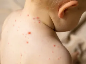 Varicelle 
