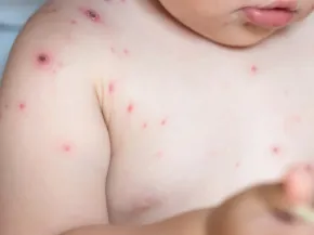 Varicelle