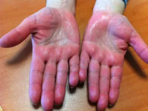 Acrocyanose avec hypersudation