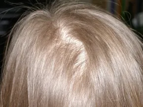 Alopécie androgénétique féminine