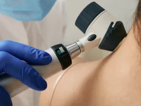 dermatoscopie