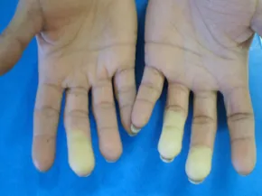 Phase syncopale du Raynaud