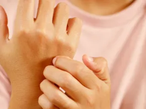 le prurit et le prurigo