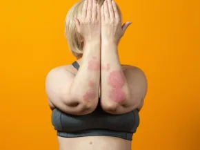 psoriasis