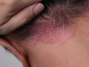 psoriasis