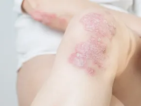 psoriasis 