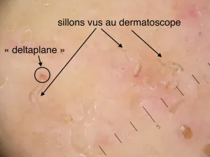 Sillons de la gale