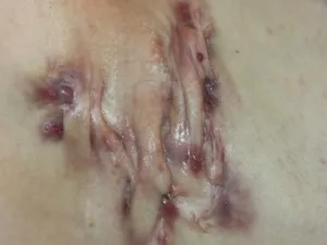 Botriomycomes