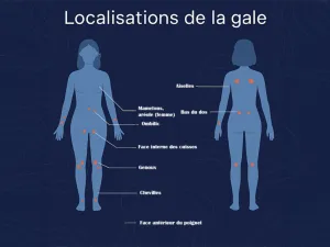 Localisation de la gale