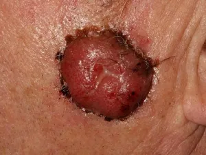 Carcinome spinocellulaire invasif typiquement lésion bourgeonnante
