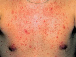 Manifestations cutanéo-muqueuses de la primo-infection à VIH