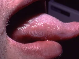 Leucoplasie orale chevelue.